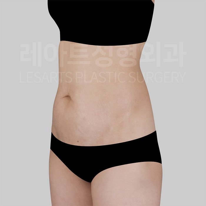 3-abdominoplasty-31233-before