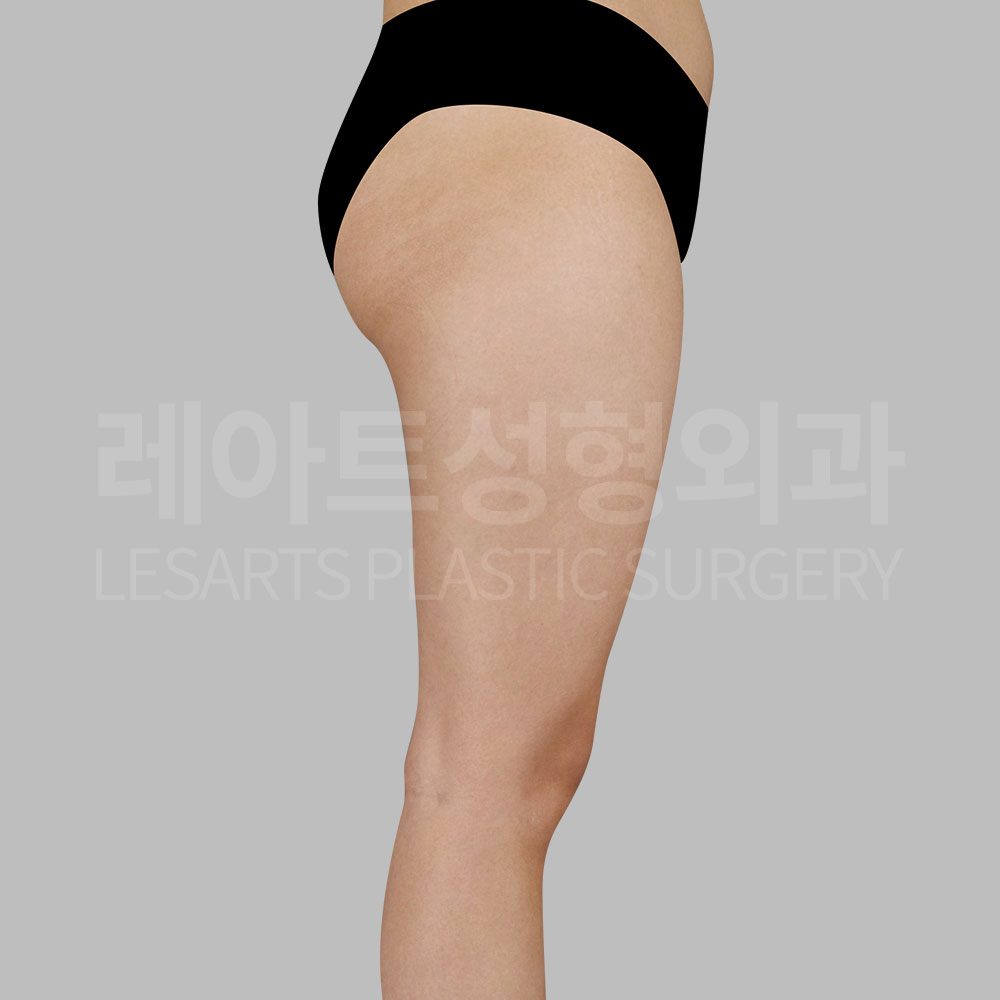 3_25862_ thigh_liposuction_side