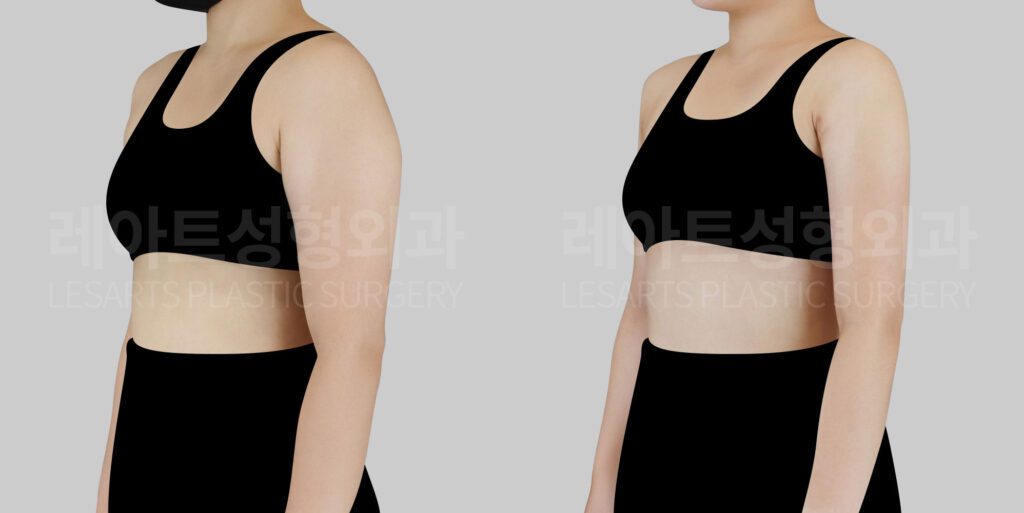 arm liposuction_팔 지방흡입