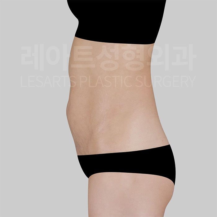 4-abdominoplasty-31233-before