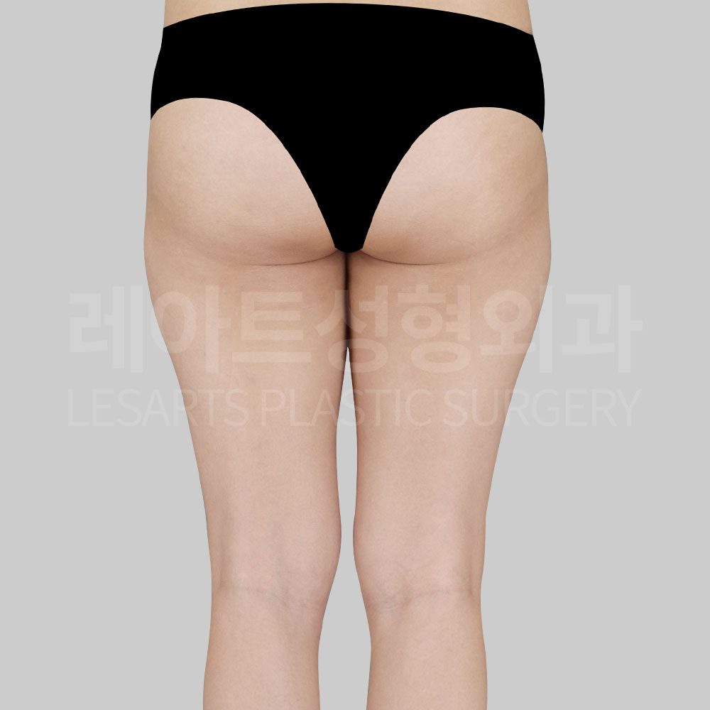 5_25862_ thigh_liposuction_back