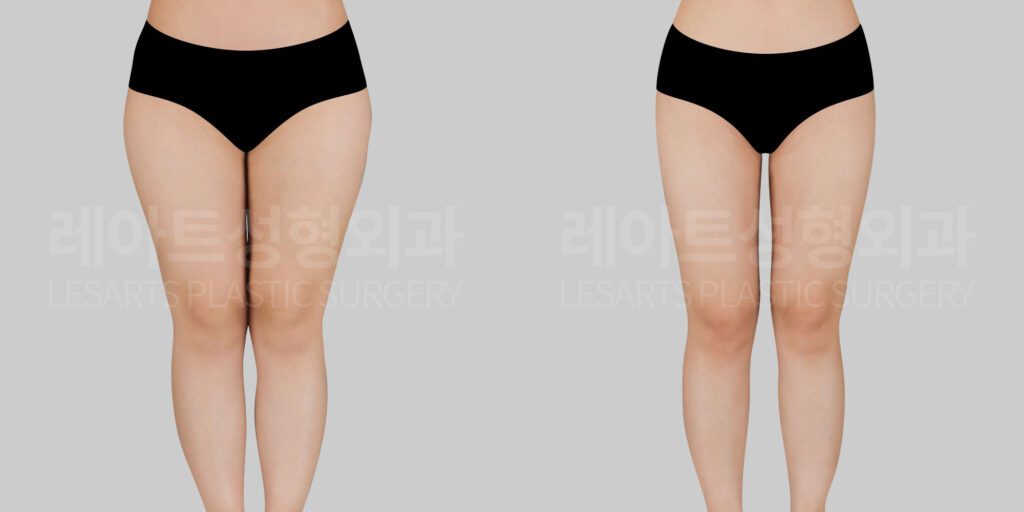 thigh_liposuction_ban_허벅지지방흡입 전후사진