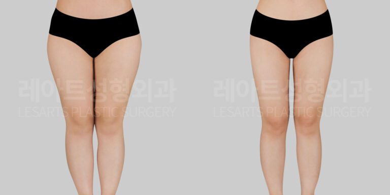 thigh_liposuction_ban_허벅지지방흡입 전후사진