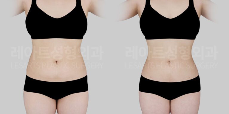 갈비뼈 돌출형 복부, 지방흡입으로 어디까지 개선 가능할까?