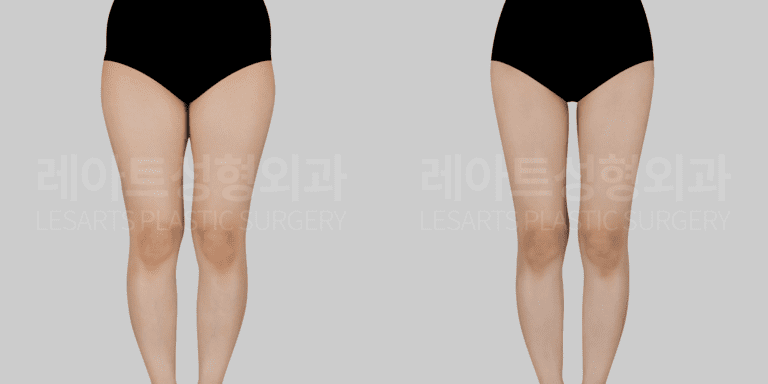 허벅지 지방흡입 전후 비교 정면