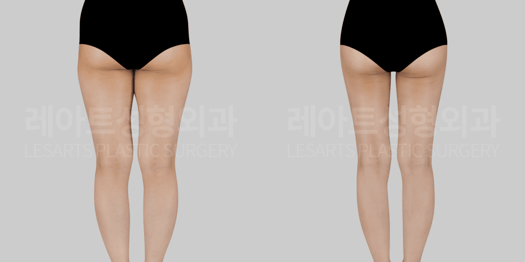 thigh_liposuction 허벅지 지방흡입 전후 비교 후면