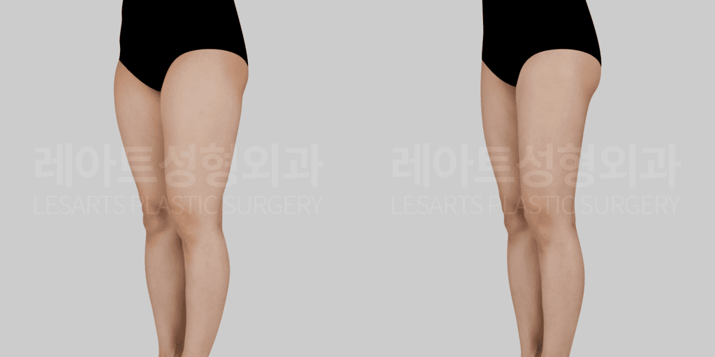 thigh_liposuction 허벅지 지방흡입 전후 비교 반측면
