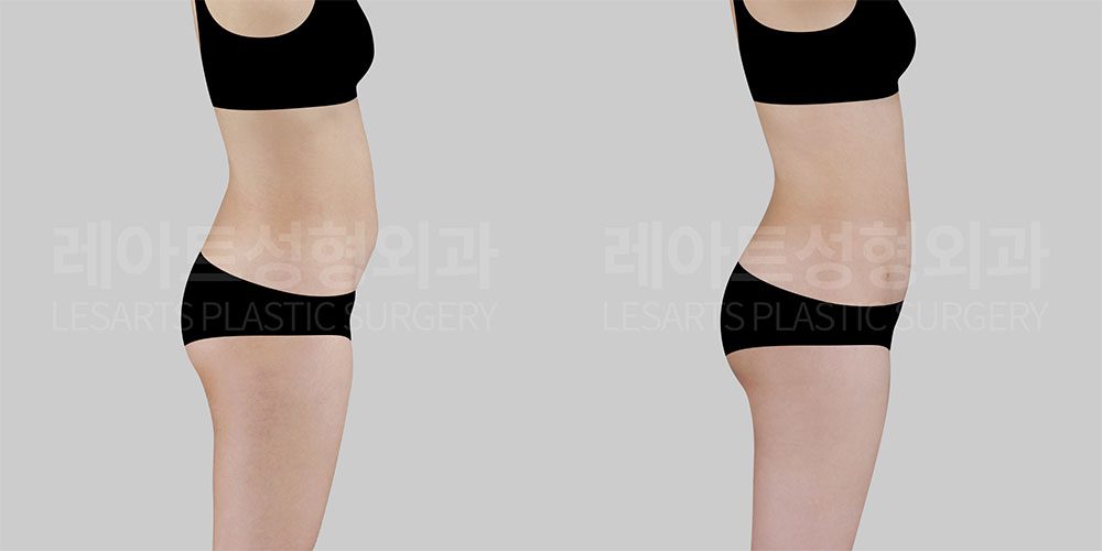 복부지방흡입 & 허벅지 지방흡입 & 고관절 지방이식 전후사진 옆면