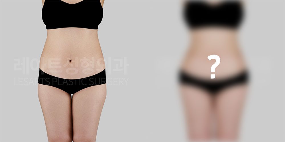 복부지방흡입 & 허벅지 지방흡입 & 고관절 지방이식 전후사진 어떻게 변할까