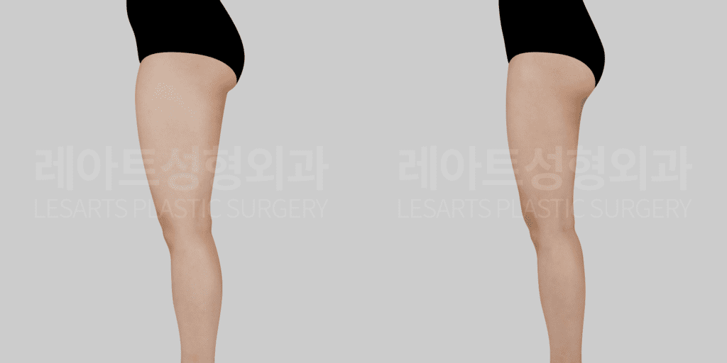 thigh_liposuction 허벅지 지방흡입 전후 비교 측면