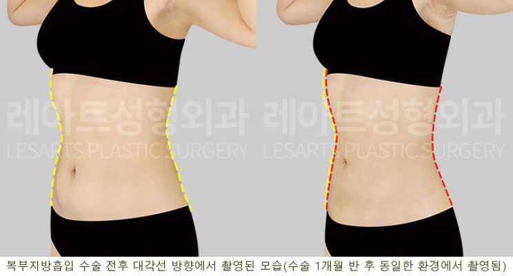 복부 지방흡입 전후사진