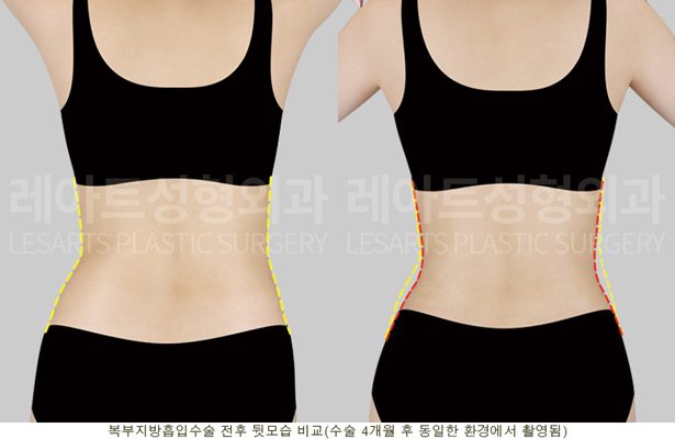 복부지방흡입 4개월 후 전후 - 정면