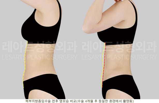 복부지방흡입 4개월 후 전후 - 측면