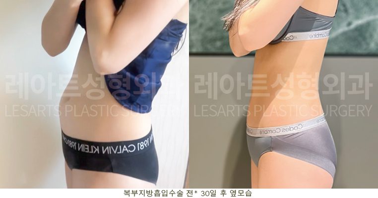 복부거상 수술 후 셀카 사진 - 옆모습