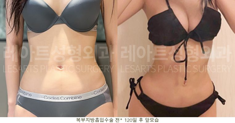 복부거상 수술 후 셀카 사진 - 정면
