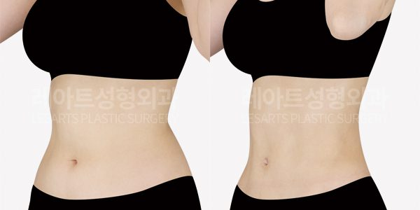 복부 지방흡입 전후