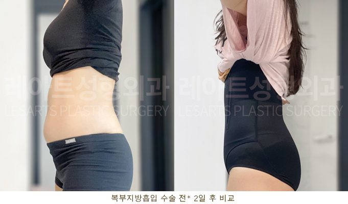 레아트 복부 지방흡입 후 셀카 전후사진