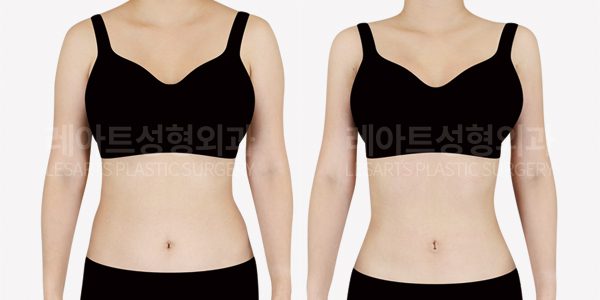 팔, 복부지방흡입 전후 사진 레아트 성형외과