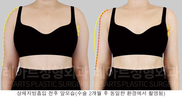 팔 지방흡입 재주술 전후사진 - 레아트 성형외과