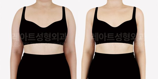 팔 지방흡입 전수 비교 사진 - 레아트 성형외과