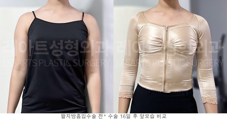 팔 지방흡입 전후 셀카