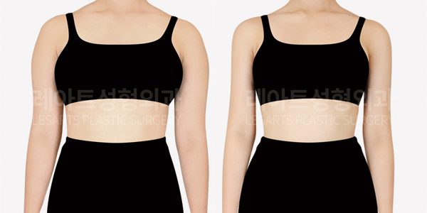 팔 지방흡입 전후사진 앞모습