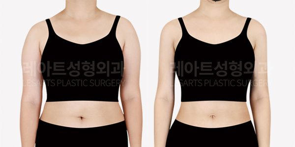 예비신부 팔 지방흡입 전후사진 앞모습