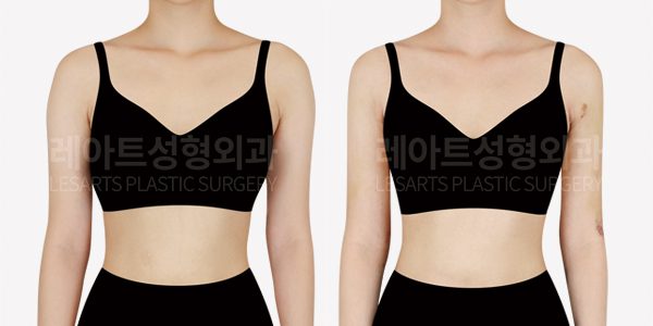 팔 지방흡입 전후 사진, 팔 지방흡입 재수술