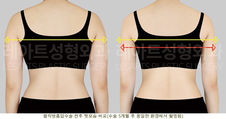 팔 지방흡입 5개월 후 전후사진