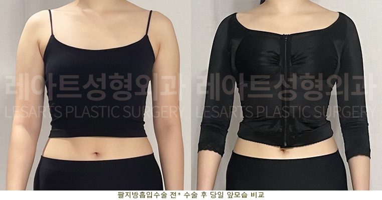 팔 지방흡입, 부유방 지방흡입, 겨드랑이 지방흡입 전후 셀카 사진