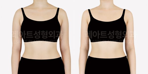 팔,부,겨 지방흡입 전후