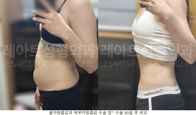팔 지방흡입, 복부 지방흡입 레아트 성형외과