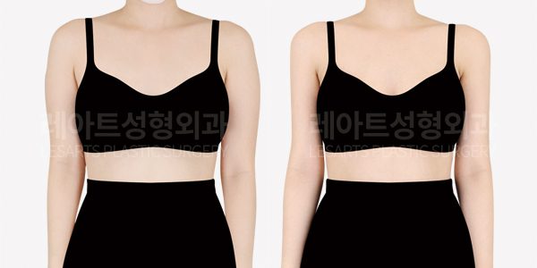 팔 지방흡입으로 상체라인 다듬기 전후사진