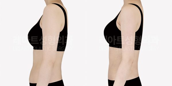 복부 지방흡입 & 팔 지방흡입으로 상체라인 다듬기