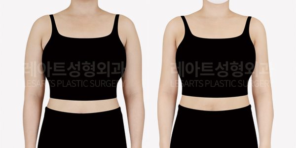 팔 지방흡입 전후사진