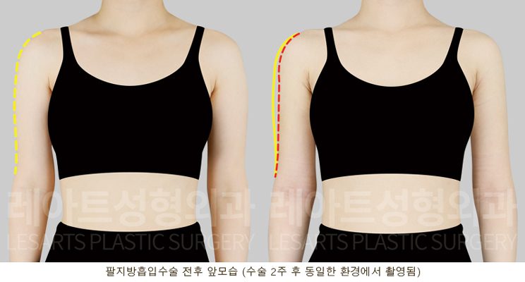 팔 지방흡입 전후 라인 비교