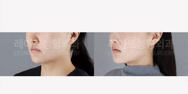 얼굴 지방흡입 - 레아트 성형외과