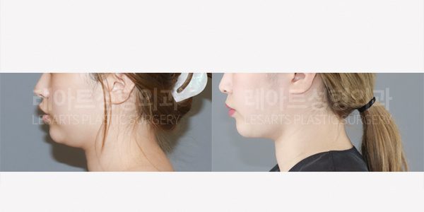 얼굴 지방흡입으로 날렵한 얼굴선 만들기 전후사진