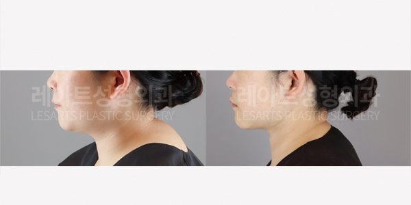 얼굴 지방흡입 전후사진 - 레아트성형외과