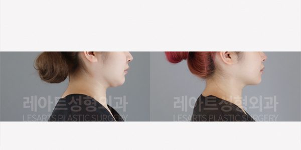 이중턱 없애는 얼굴 지방흡입 전후 사진