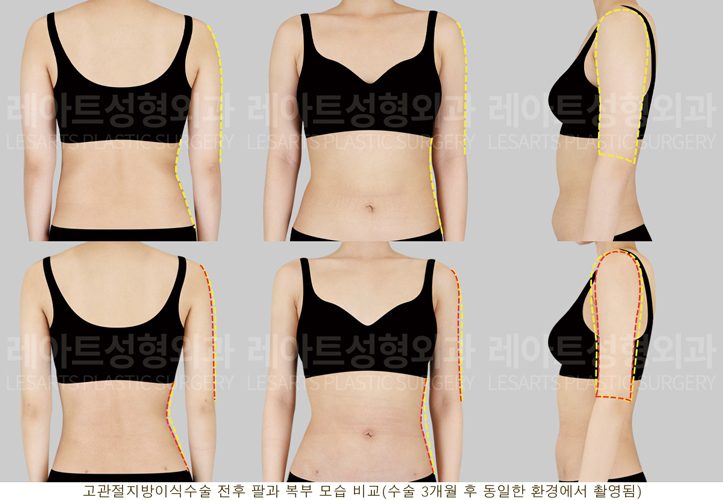 복부 지방흡입, 팔 지방흡입 전후사진