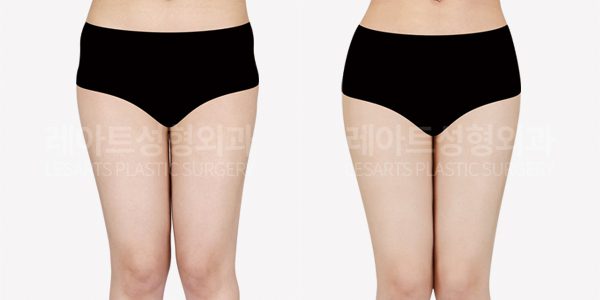 골반 지방이식 전후사진