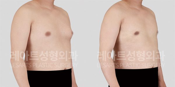 여유증 수술 후 전후 사진