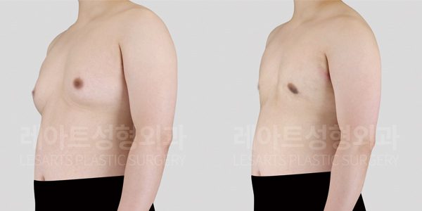여유증 수술 후 전후사진 옆모습