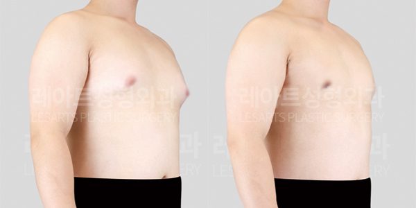 여유증 수술 후 전후사진 그레이드 2-a