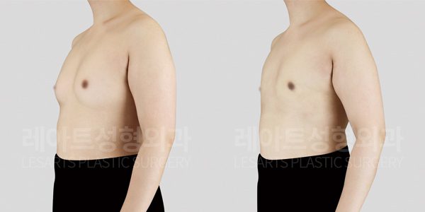 그레이드2-a 여유증 수술 전후 사진 옆모습