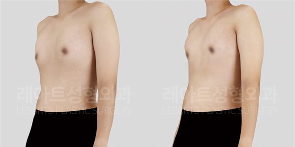 여유증 수술 전후 옆모습, 옆가슴 지방흡입 병행