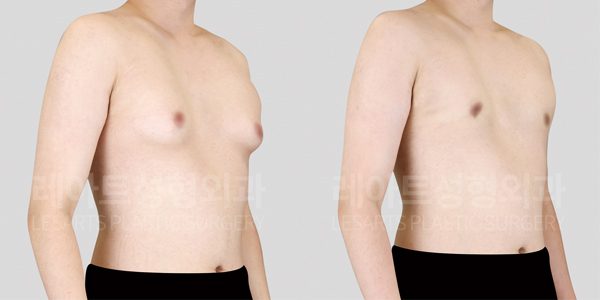 여유증 수술 전후사진 그레이드 2-b