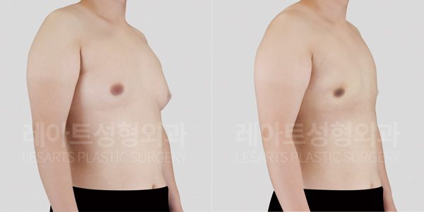 여유증 수술 전후사진 그레이드 2-b