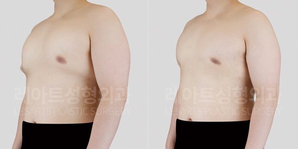 여유증 수술 전후 사진 그레이드 2-a